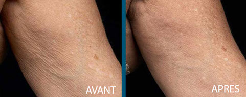 avant après thermage centre laser clipp paris 4