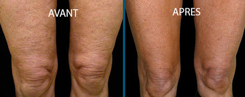 avant après thermage centre laser clipp paris 1