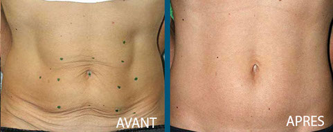 avant après thermage centre laser clipp paris