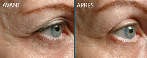 avant après thermage centre laser clipp paris 2