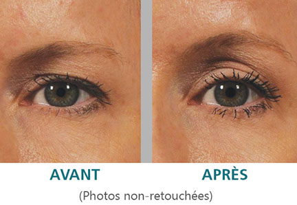 Ultrasons Ulthera à Paris pour rajeunir visiblement les contour des yeux: résultats et avis.