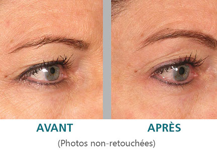 Ulthera: le traitement pour rajeunir le regard et le contour des yeux, sans chirurgie à Paris.