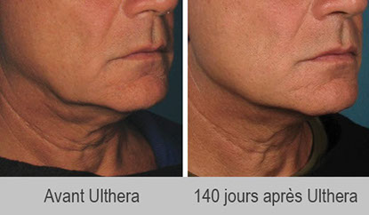 Ultrasons Ulthera ou Ultherapy: le lifting sans chirurgie pour les hommes et les femmes à Paris.