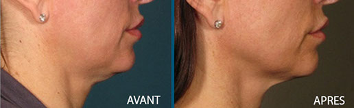 avant après rajeunissement 2