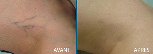 avant après vasculaire