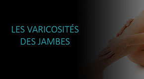 Varicosités des jambes: origines et solutions.