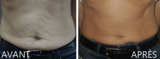 Résultats Exilis sur la peau du ventre relâchée.