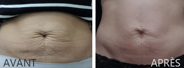 Peau flétrie, relâchée autour du nombril: solutions et traitements au CLIPP à Paris.