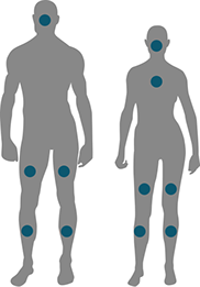 ZONES TRAITÉES AVEC LES LASERS VASCULAIRES